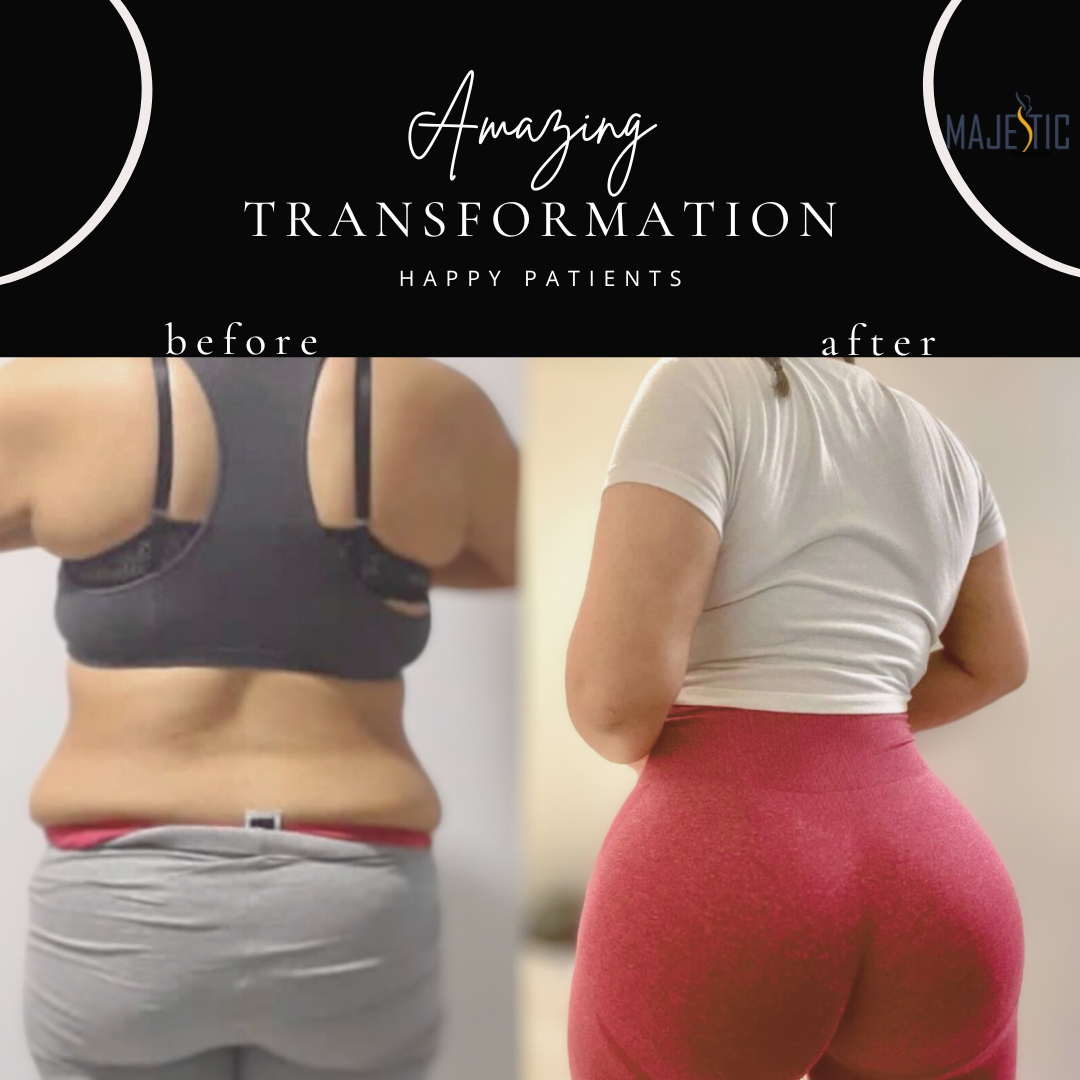 before and afer liposuction pictures